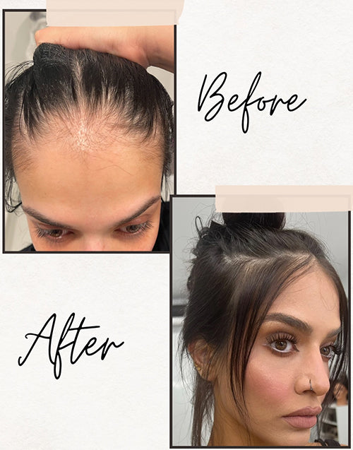 Before and after comparison of hairline topper showing transformation from thinning hairline to natural, seamless volume.